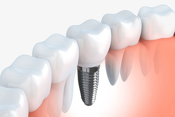 single dental implant placement and restoration