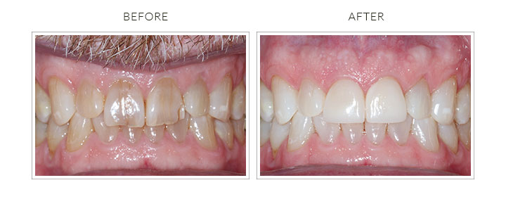 before and after photo of cosmetic dental veneers