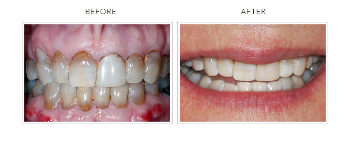 before and after photo of teeth whitening