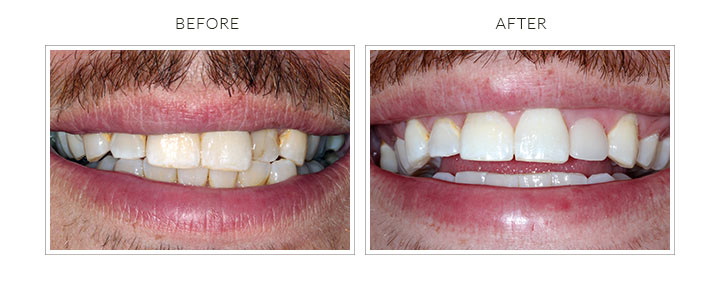 before and after dental crown and whitening