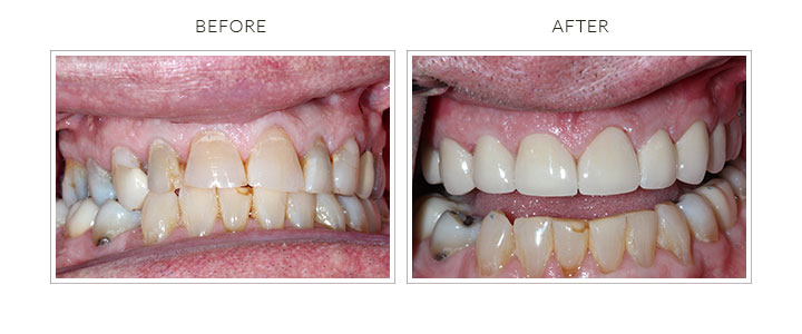 before and after upper dental crowns