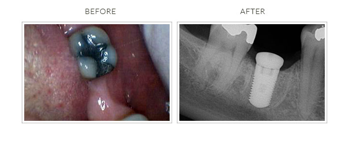 before and after dental implant placement