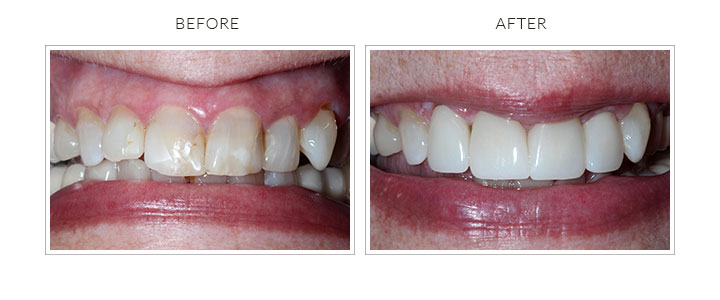 before and after porcelain crowns
