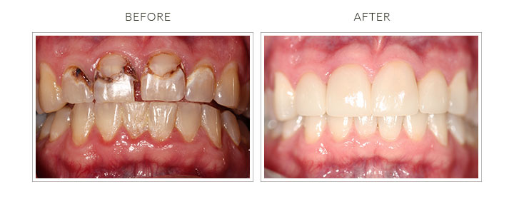before and after porcelain crowns and teeth whitening