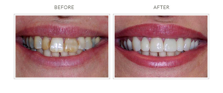 before and after cerec crowns