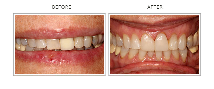 before and after whitening