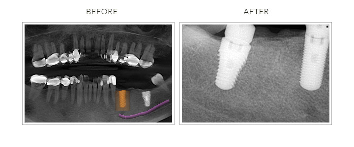 before and after dental implant placement