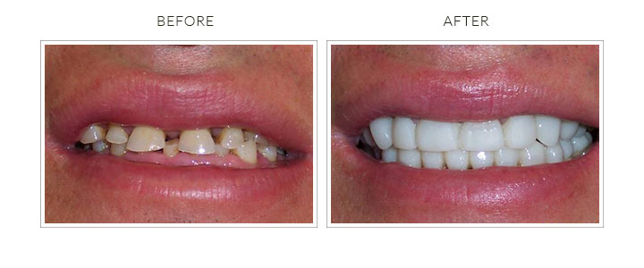 before and after full mouth restoration